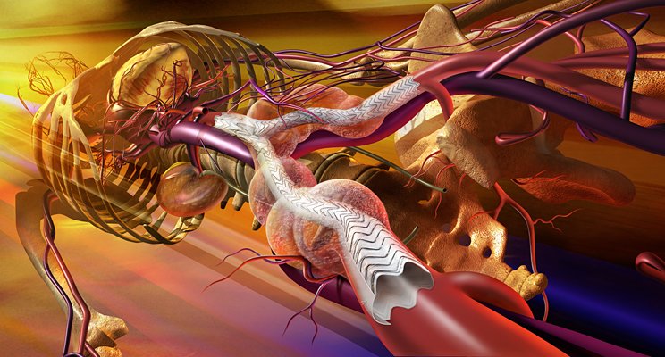 Endoprótesis aorta